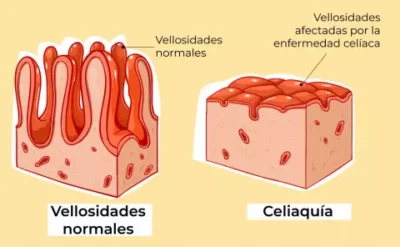 Vellosidades de la celiaquía
