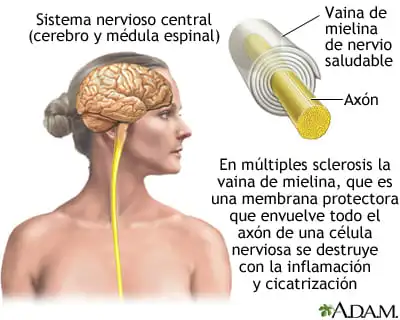 esclerosis múltiple