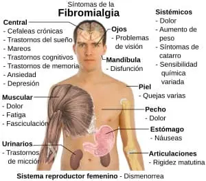 Síntomas de fibromialgia