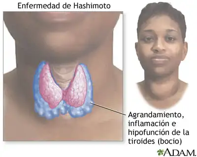 Enfermedad de Hashimoto