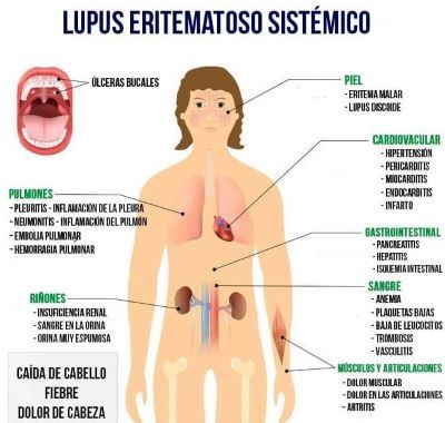 Síntomas de lupus