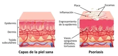 Piel sana y piel con psoriasis