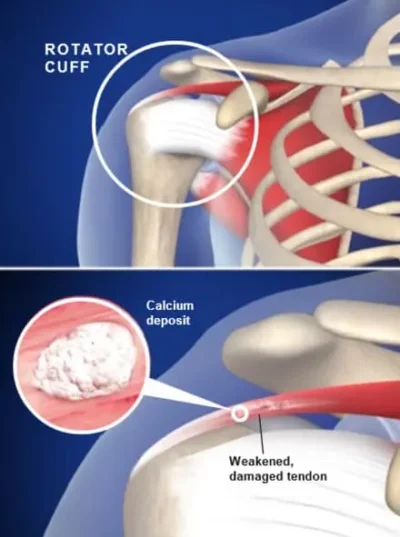 Calcificación hombro