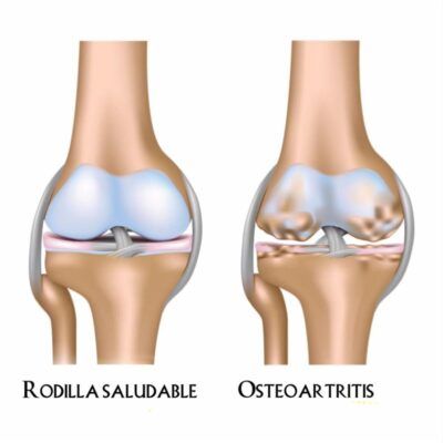 Osteoartritis de rodilla