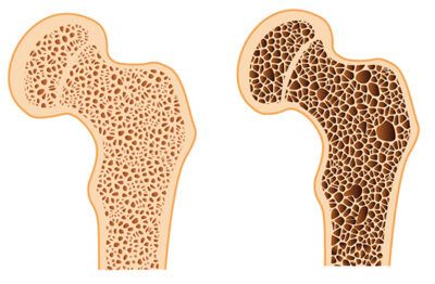 Osteoporosis del fémur