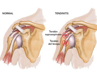 tendinitis del hombro